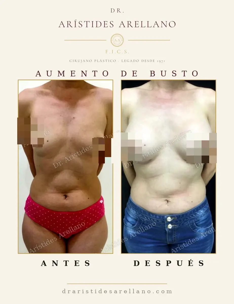 Antes y después de aumento de busto: caso real del Dr. Arístides Arellano (3 de 4)