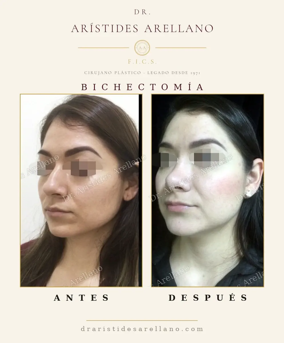 Antes y después de bichectomía: caso real del Dr. Arístides Arellano (1 de 4)