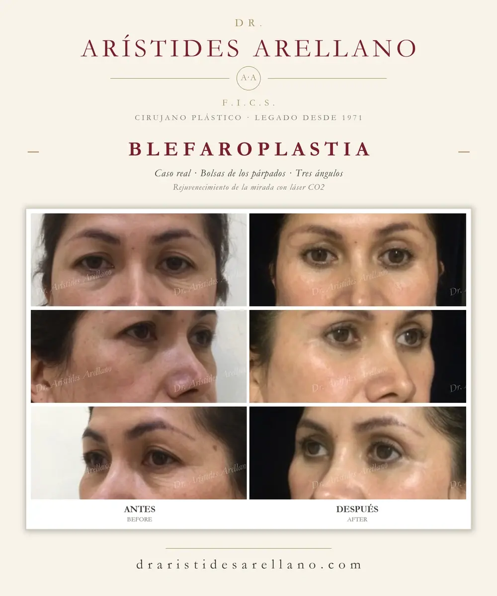 Antes y después de blefaroplastia: caso real del Dr. Arístides Arellano (1 de 4)