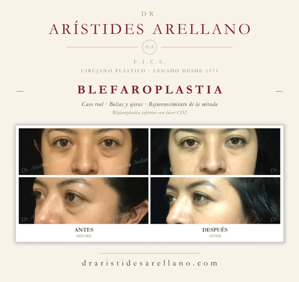 Antes y después de blefaroplastia: caso real del Dr. Arístides Arellano (2 de 4)