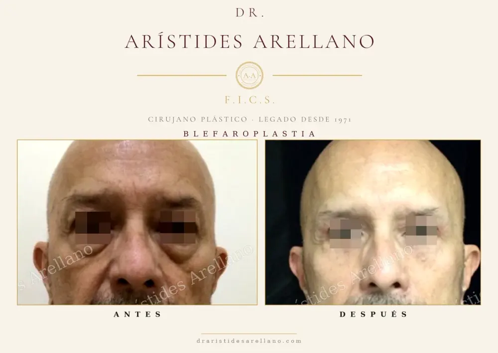 Antes y después de blefaroplastia: caso real del Dr. Arístides Arellano (4 de 4)