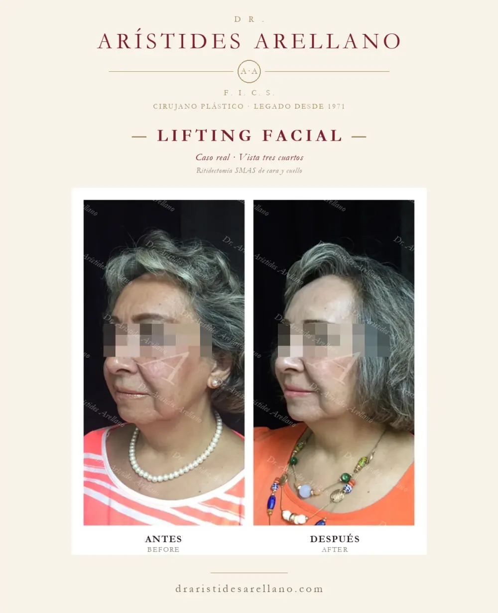 Antes y después de lifting facial: caso real del Dr. Arístides Arellano (2 de 4)