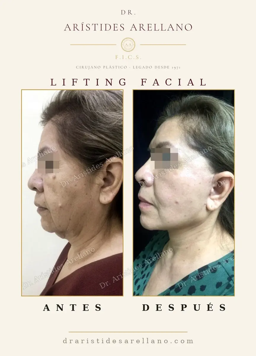 Antes y después de lifting facial: caso real del Dr. Arístides Arellano (4 de 4)