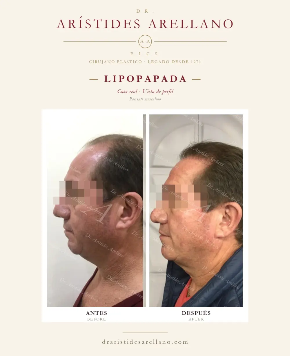 Antes y después de lipopapada: caso real del Dr. Arístides Arellano (3 de 4)