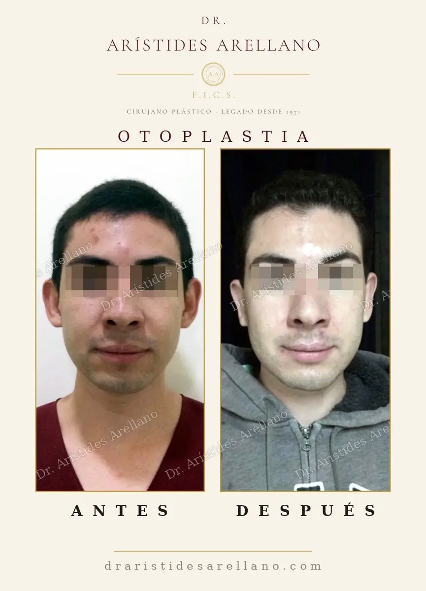 Antes y después de otoplastia: caso real del Dr. Arístides Arellano (2 de 2)