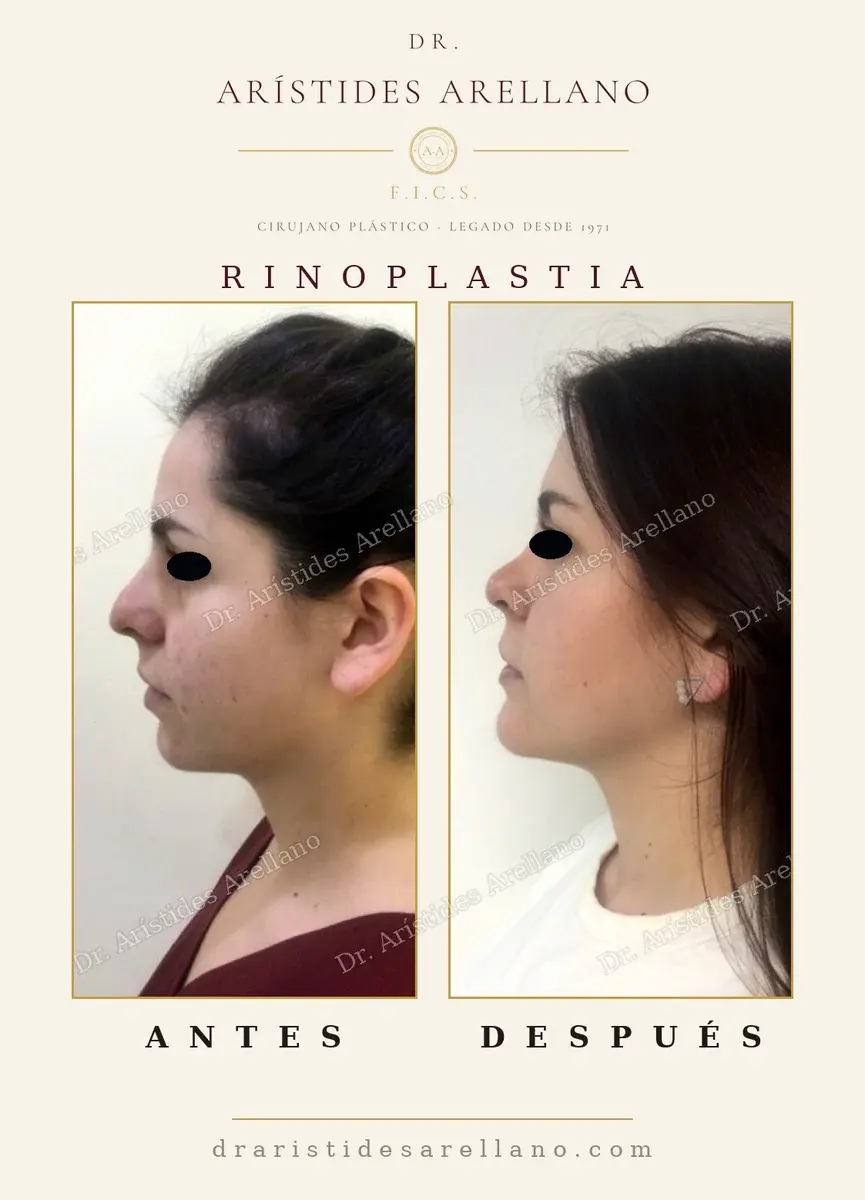 Antes y después de rinoplastia: caso real del Dr. Arístides Arellano (1 de 4)