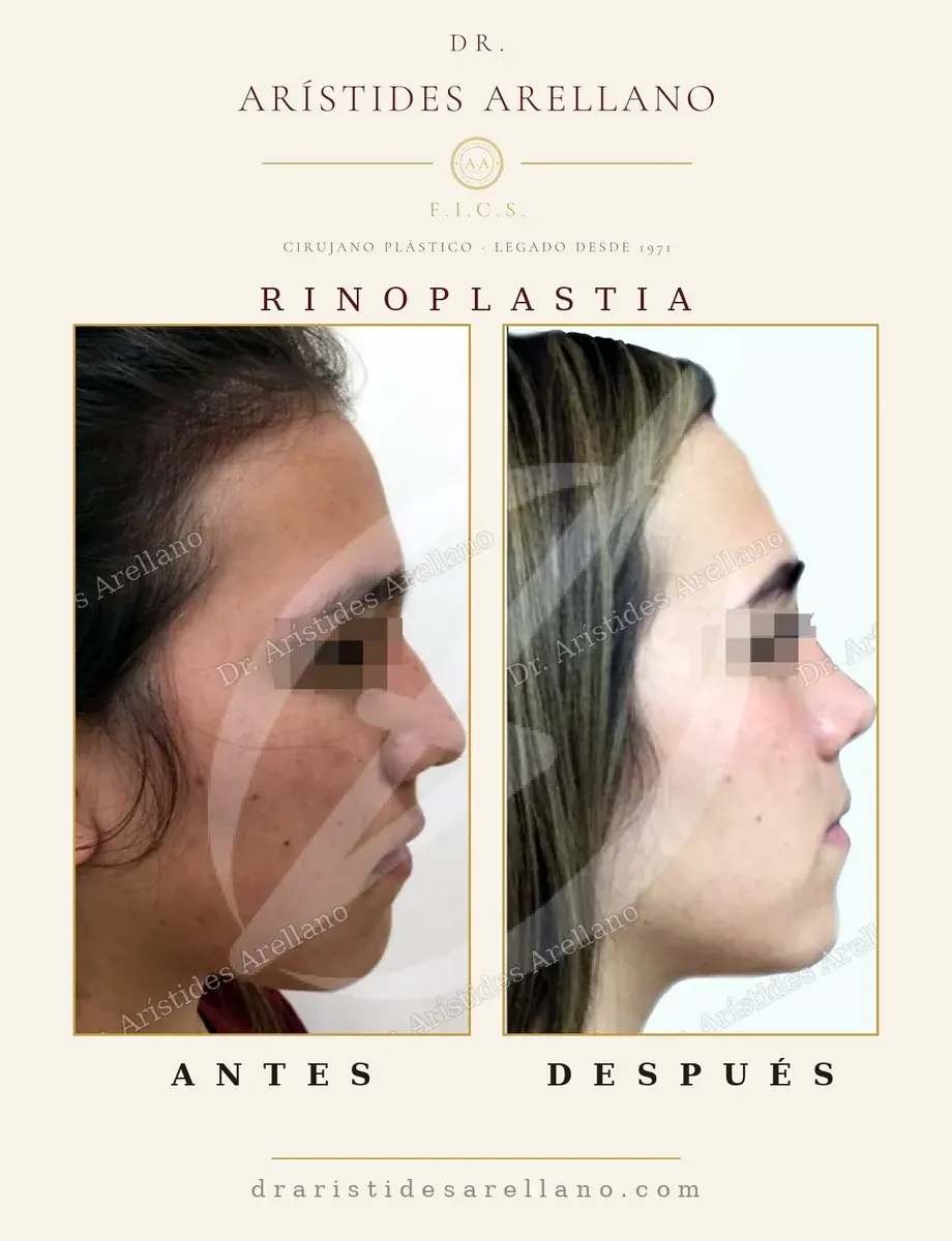 Antes y después de rinoplastia: caso real del Dr. Arístides Arellano (2 de 4)