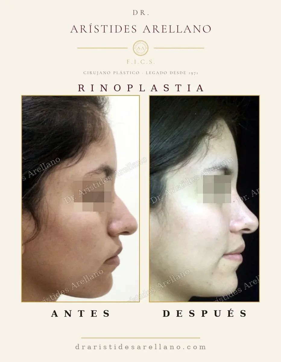 Antes y después de rinoplastia: caso real del Dr. Arístides Arellano (3 de 4)